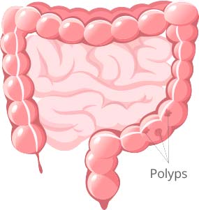Polyps in colon may lead to colon cancer