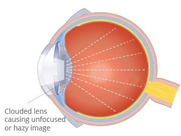 clouded lens causing unfocused / blurry image