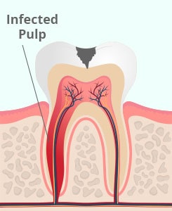 Tooth with infected pulp