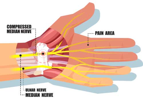 Carpal-Tunnel-Syndrome