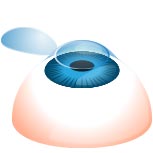 LASIK surgery - Step 1 - Cornea flap creation LASIK surgery - Step 1 - Cornea flap creation