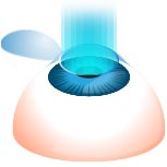 LASIK surgery - Laser Sculpting the Corneal LASIK surgery - Laser Sculpting the Corneal