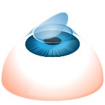 LASIK surgery - The Corneal Flap is Replaced
