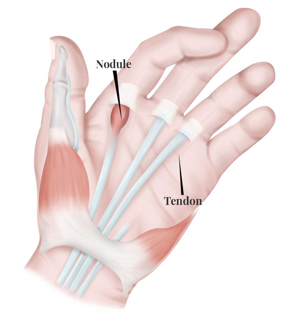 Finger and Fingers Locking Up (and More Causes)