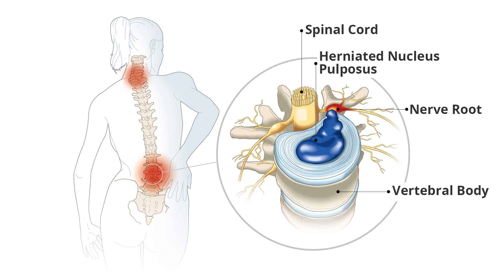 Back Pain? Neck Pain? Ask Dr. McLain - ROBERT MCLAIN, M.D. - NECK AND BACK  SURGERY