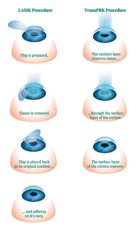 LASIK surgery vs PRK surgery