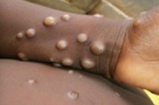 monkeypox infection - WHO source