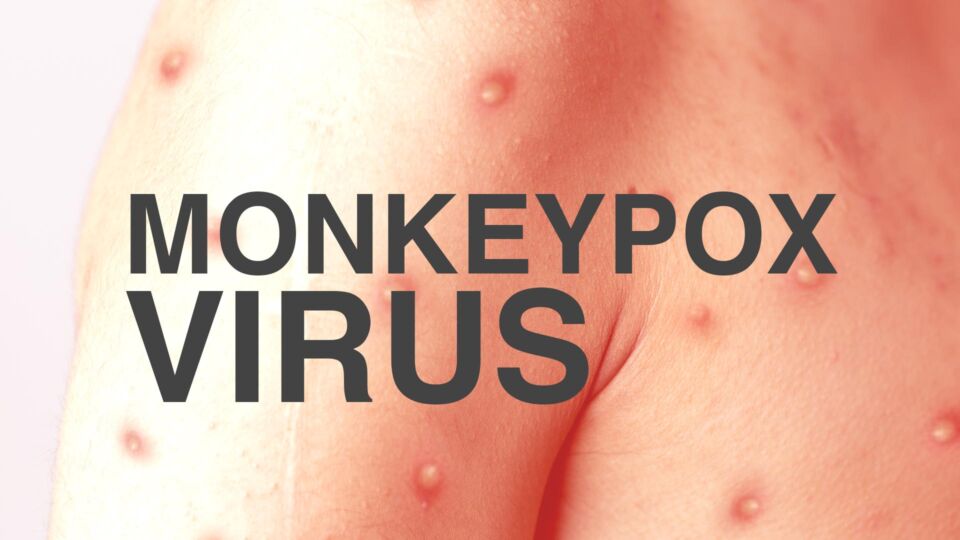 Monkeypox viral disease article Monkeypox viral disease article