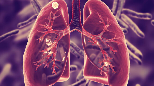 Raffles Medical article Tuberculosis TB