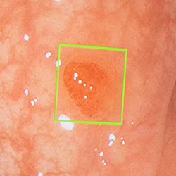 GI Genius assesses and processes each frame to highlight potential polyps and tumours