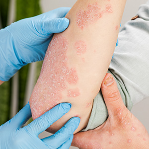 Psoriasis symptoms - Patch Rash on Skin
