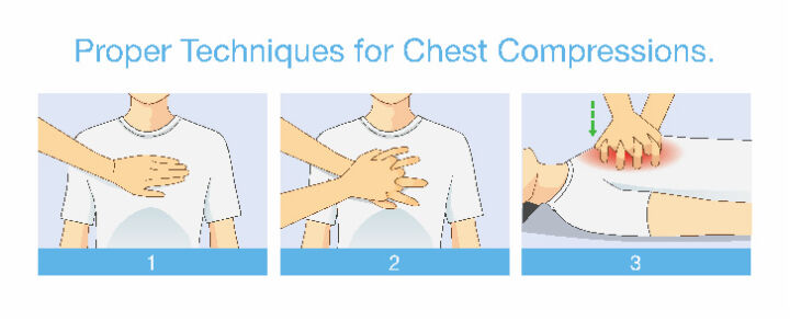 CPR chest compressions