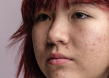 Another common symptom of an unhealthy gut is acne