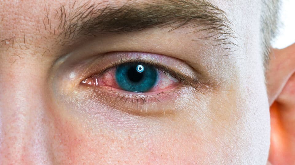 Conjunctivitis red eyes