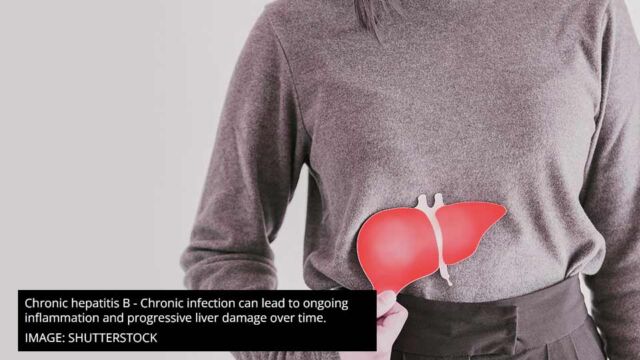 Chronic hepatitis B Chronic infection can lead to ongoing inflammation and progressive liver damage over time