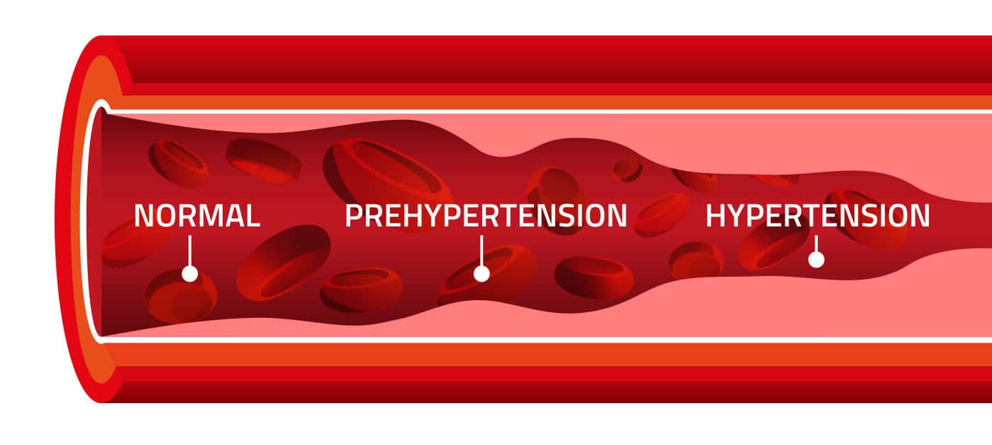 blood pressure - normal to hypertension