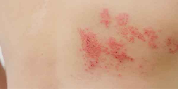 Most common complication of shingles