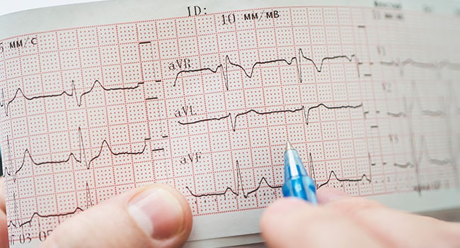 Electrocardiogram EKG/ECG aka Electrocardiography