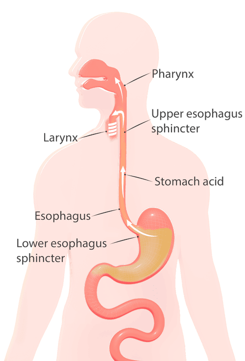 Acid from the stomach to flow back into the oesophagus and cause irritation to the oesophagus lining