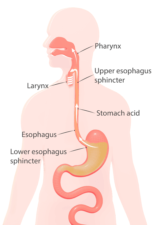 Acid from the stomach to flow back into the oesophagus and cause irritation to the oesophagus lining Acid from the stomach to flow back into the oesophagus and cause irritation to the oesophagus lining
