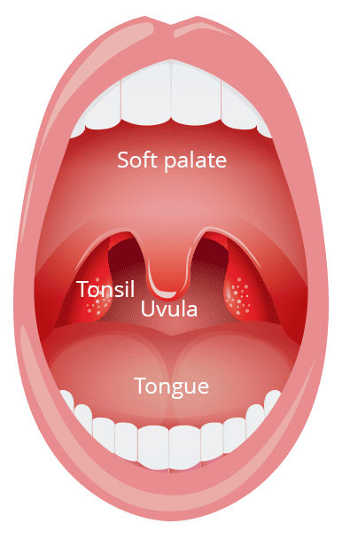 Inflamed tonsils