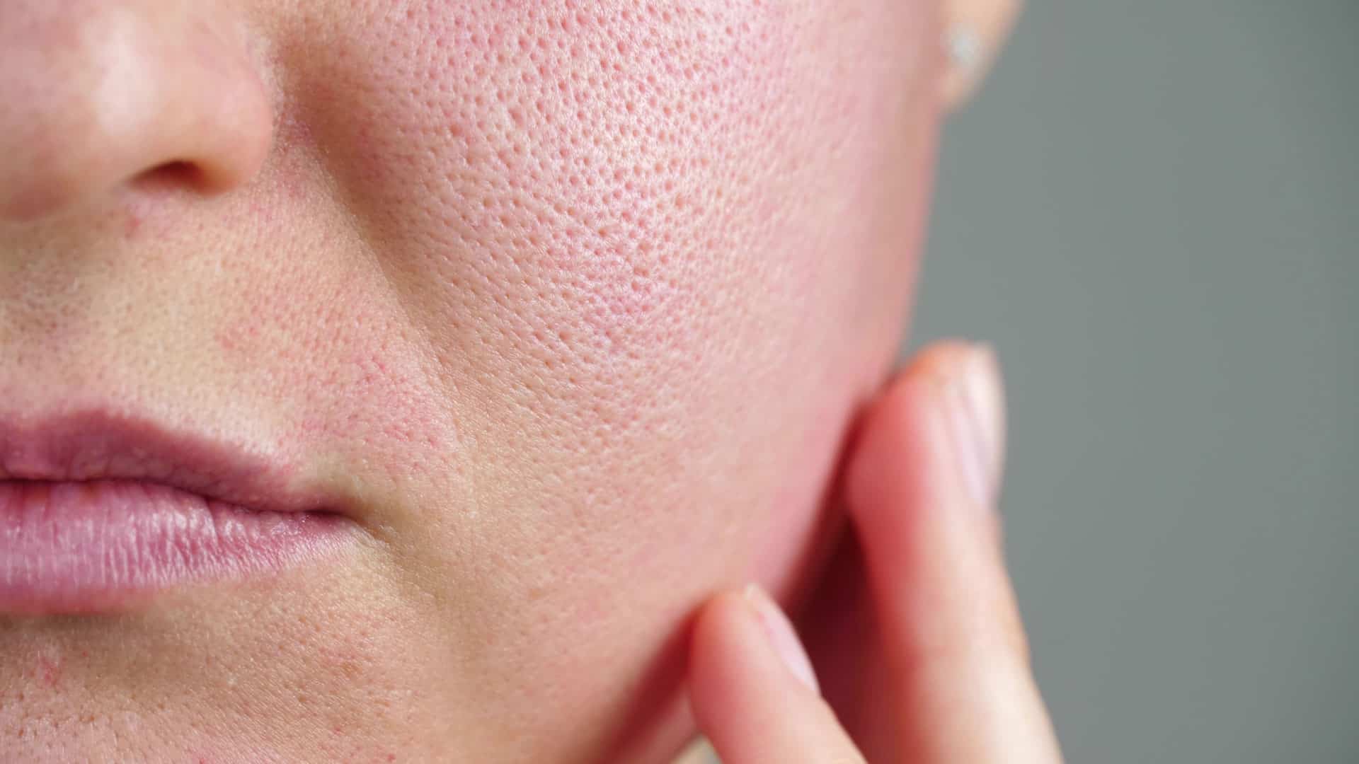 enlarge pores suitable for spectra laser peel