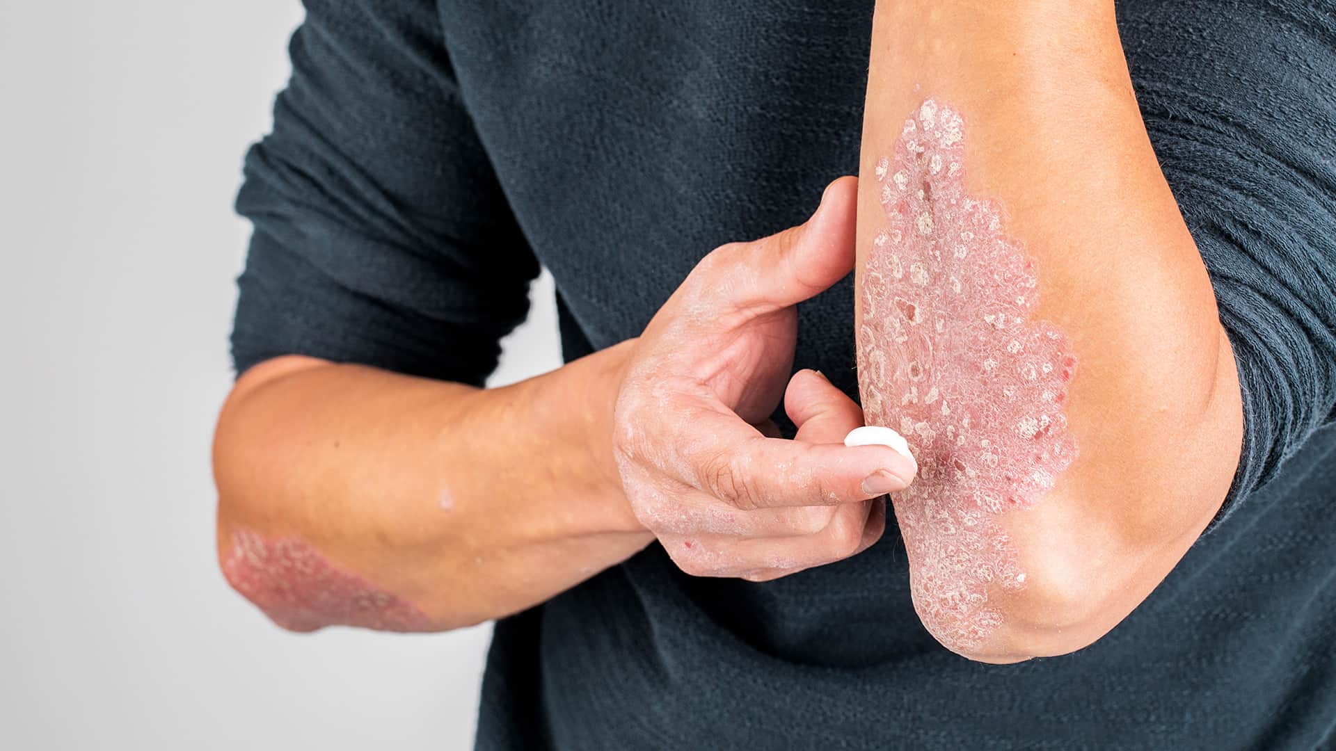 psoriasis conditions -apply topical creams or ointments on affected areas psoriasis conditions -apply topical creams or ointments on affected areas
