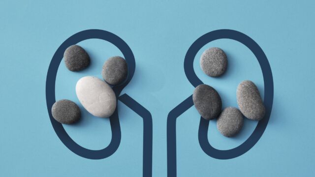 kidney stones what you need to know