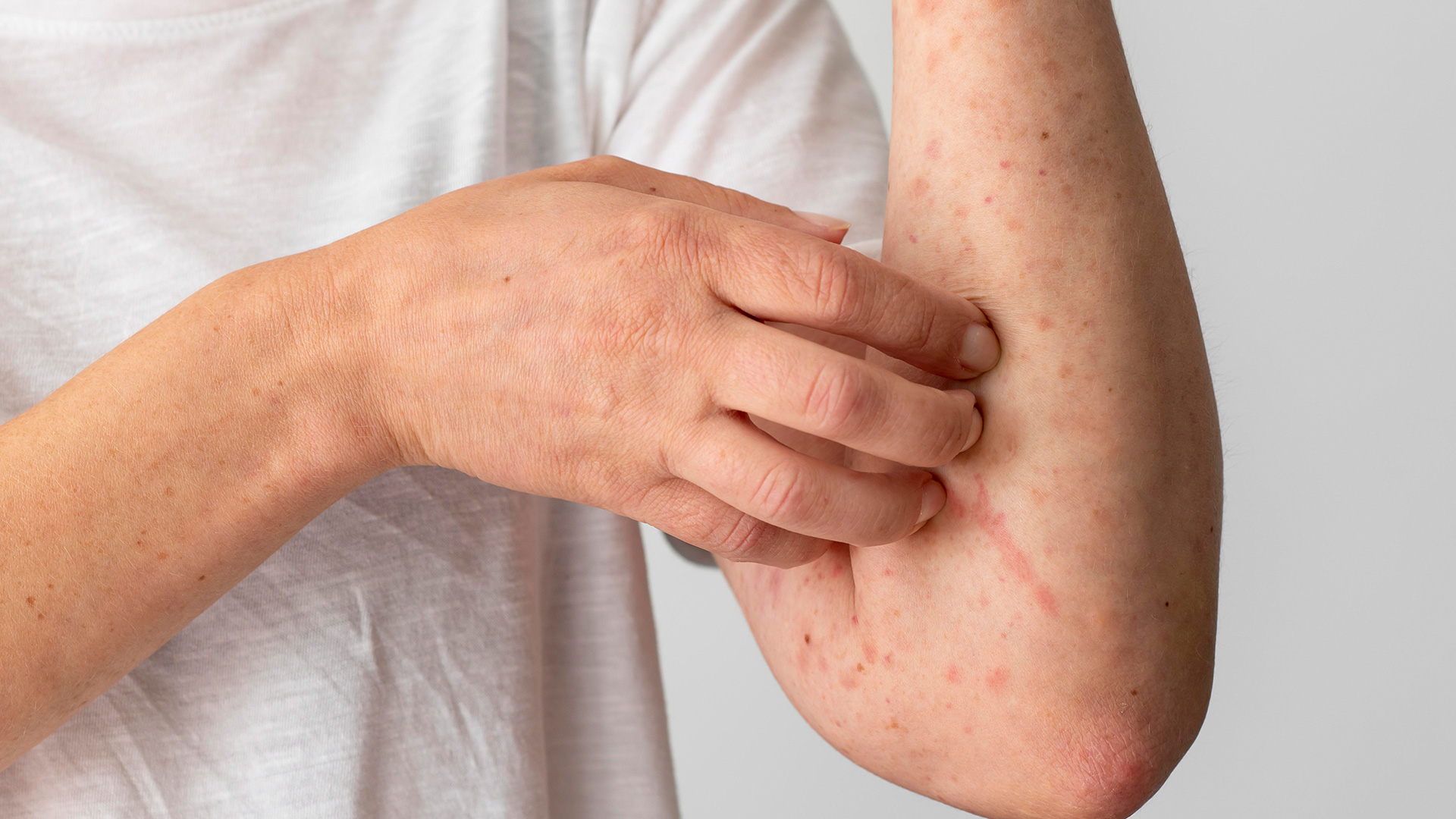 Measles is one of the most contagious viral infection known